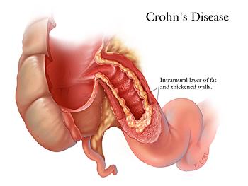 Enfermedad-Crohn