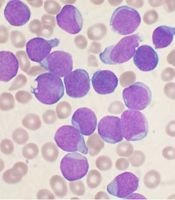 leucemia