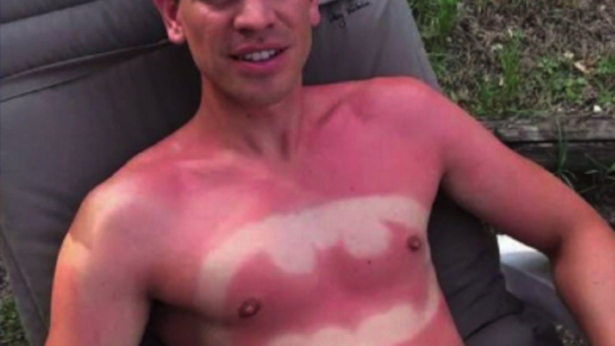 sunburn-art