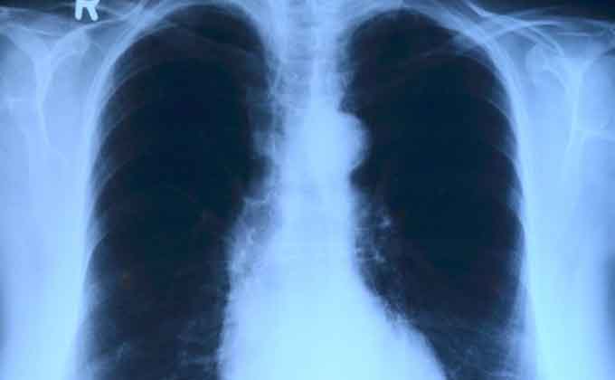 pulmones-radiografia-tumor-de-pulmon