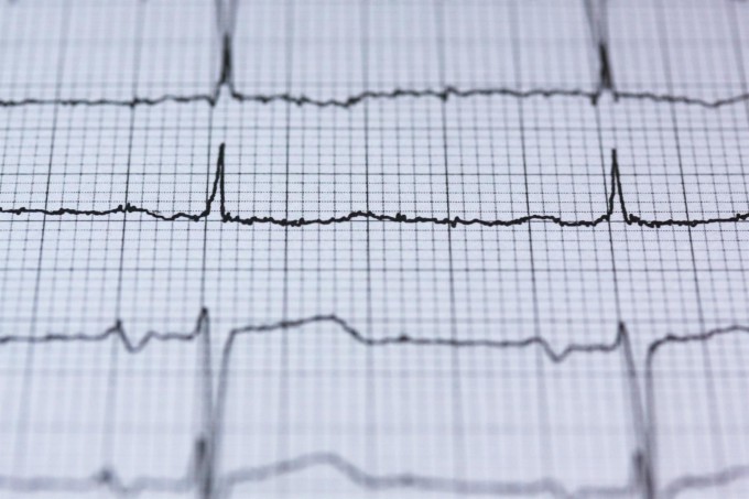 electrocardiograma