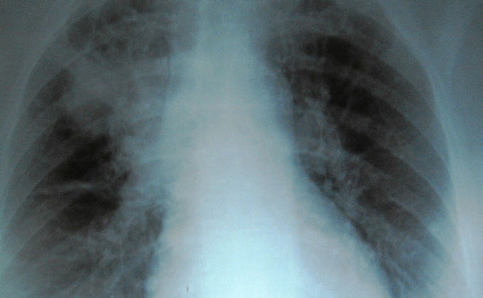 Radiografía de pulmones con fibrosis quística.