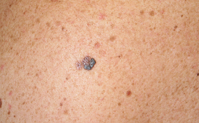 MELANOMA CANCER PIEL