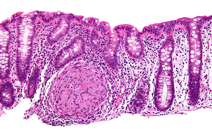 colon inflamado crohn