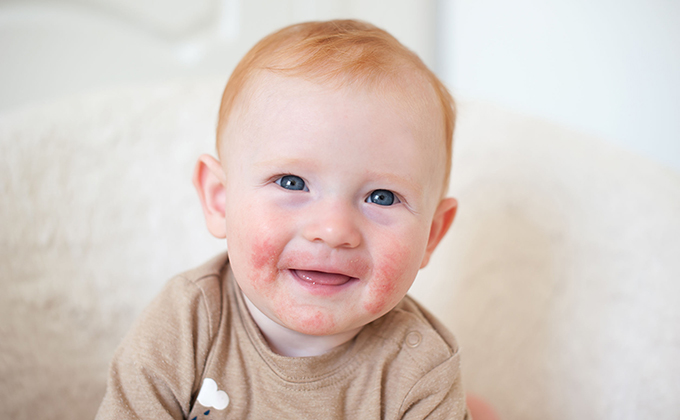 Manifestation of an allergy on the face of the child