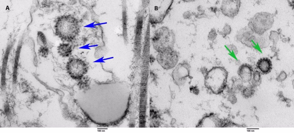 A la izquierda, el tejido de un paciente vivo previamente COVID positivo. A la derecha, el tejido recogido por autopsia de una persona que murió de COVID. Las flechas apuntan a las partículas virales de COVID en ambos especímenes.