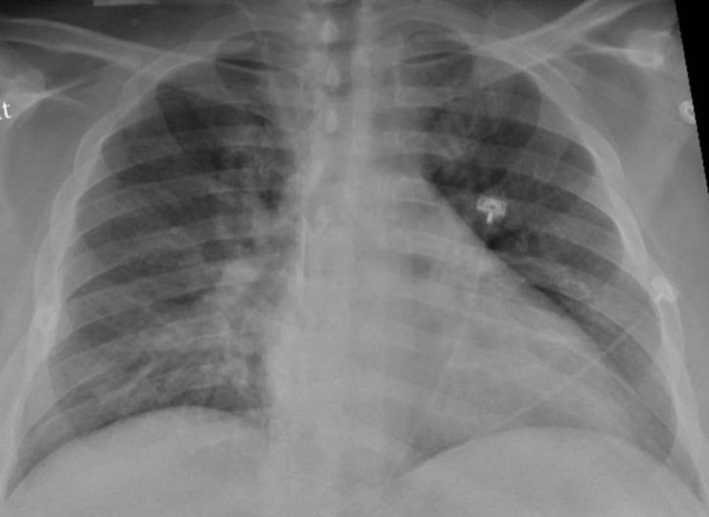 Cvirus.- La mayoría de los pulmones se recuperan bien tres meses después del pasar el COVID-19 con gravedad