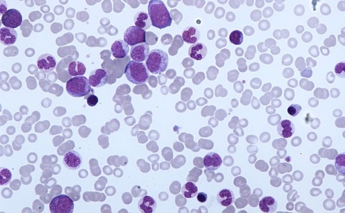 leucemia