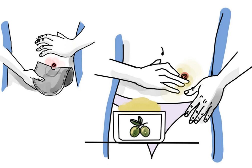 Ilustración de la aplicación del producto en pacientes.