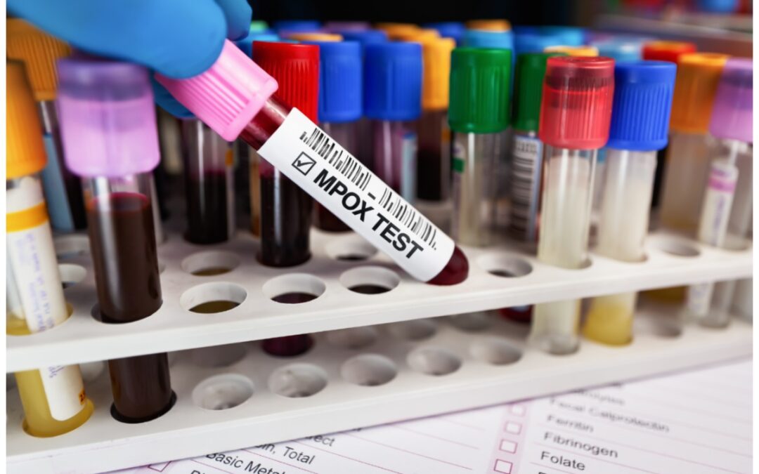 Un estudio de ibs.Granada evalúa un ensayo automatizado para la detección del virus de la viruela del mono